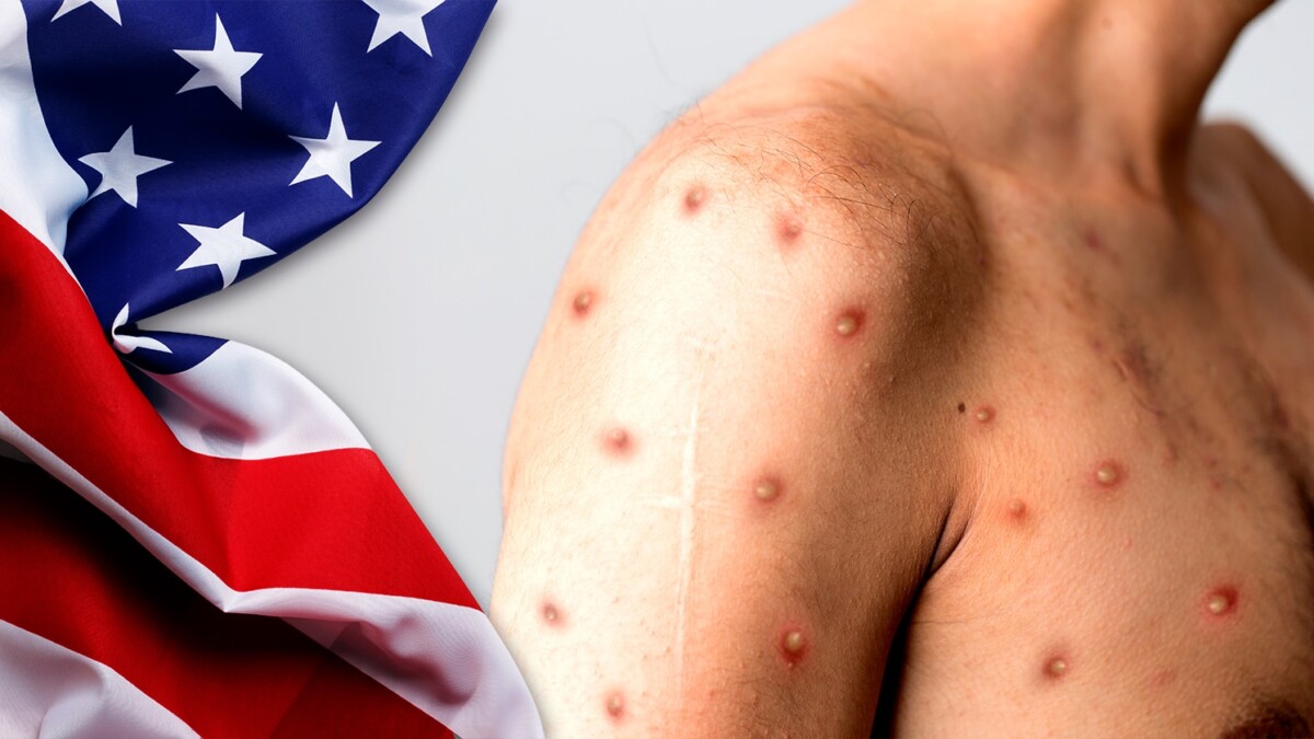 First Death from Alaskan Pox in the United States