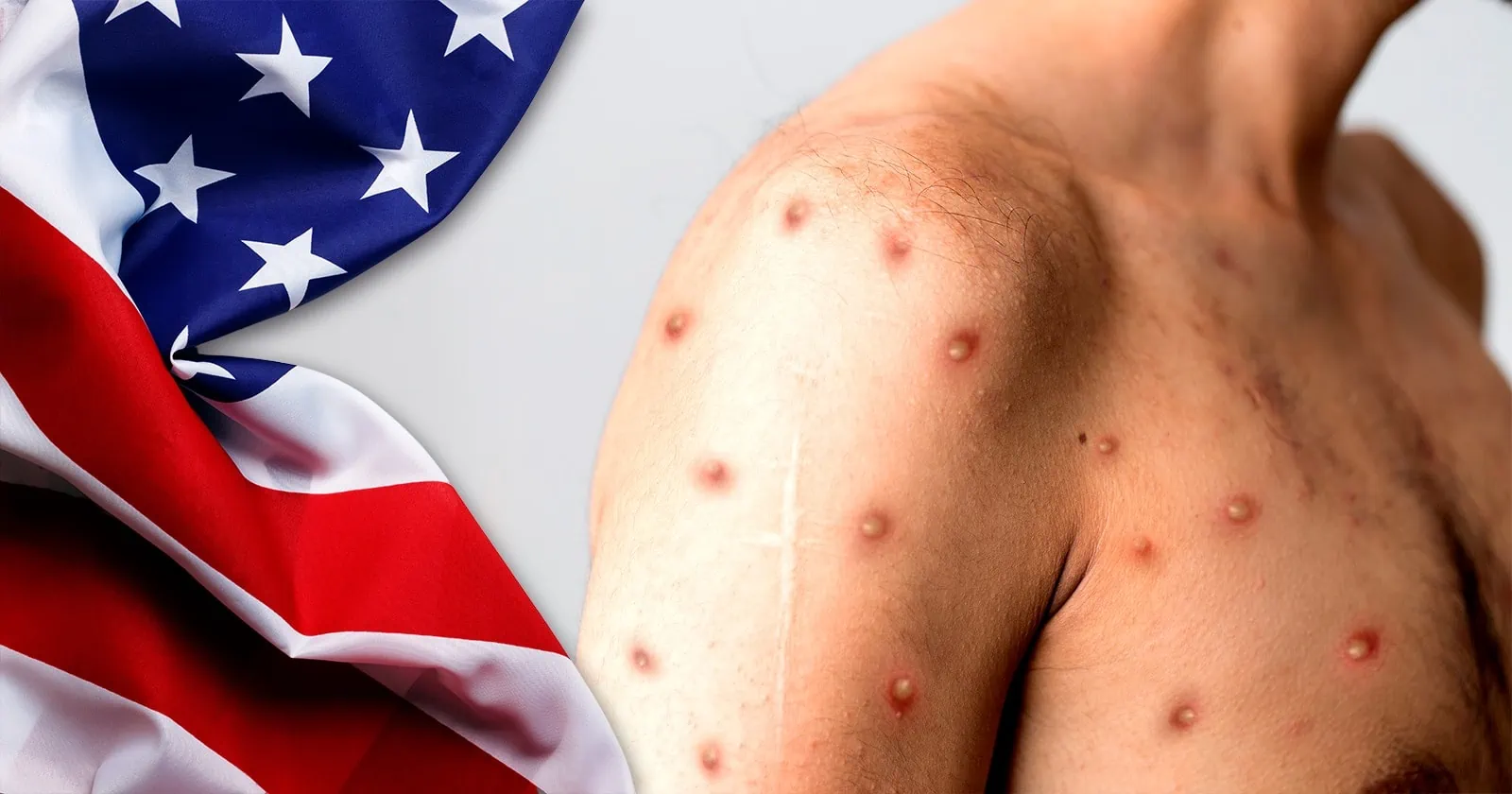 First Death from Alaskan Pox in the United States